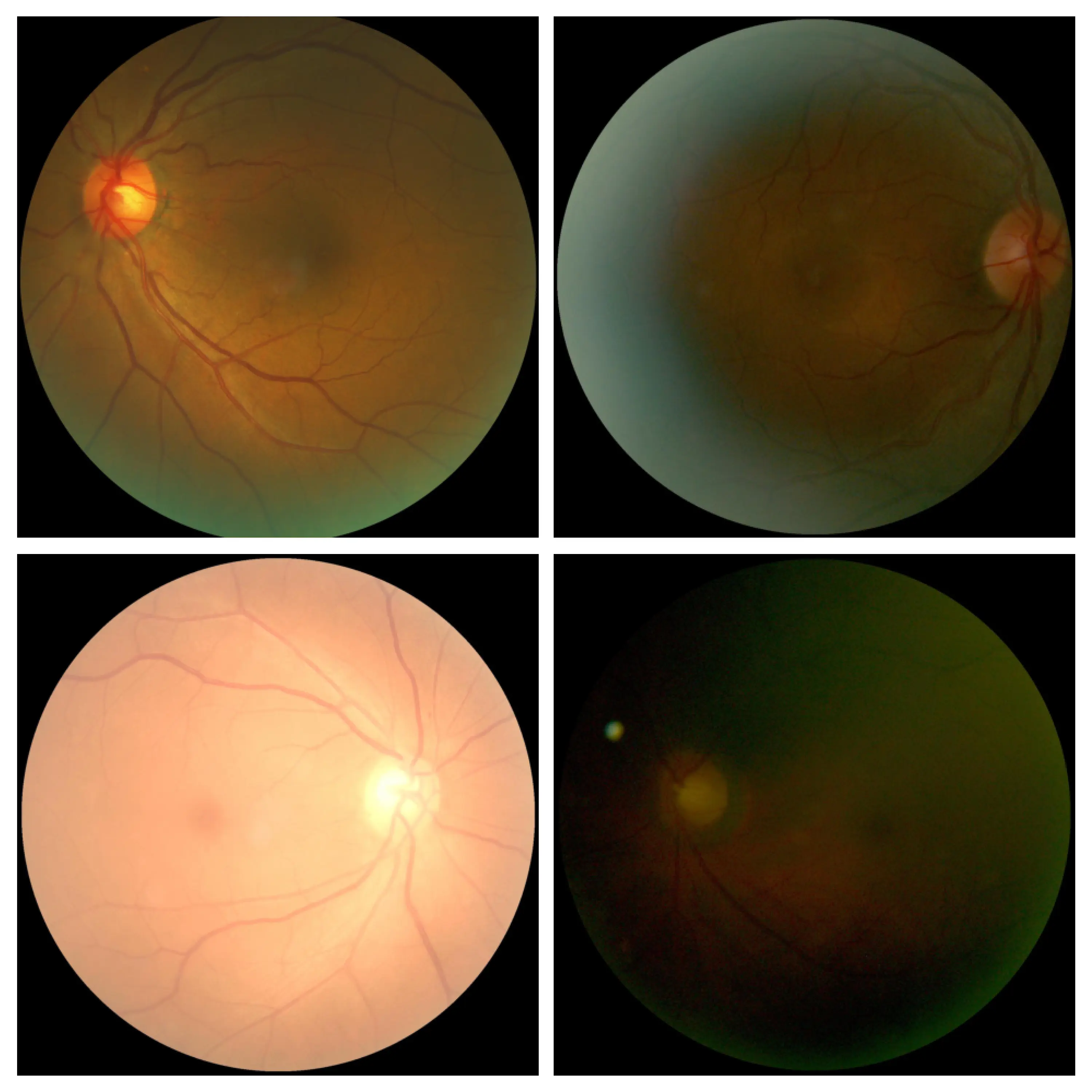 Fundus images from datasets with the minimum and maximum entropy. The top row consists of diabetic and normal fundus images, respectively, which have the minimum entropy. The bottom row consists of diabetic and normal fundus images, respectively, which has maximum entropy. We note that the model has highest confidence in its predictions when the image is clear, and the least confidence when the image is under or over-exposed.