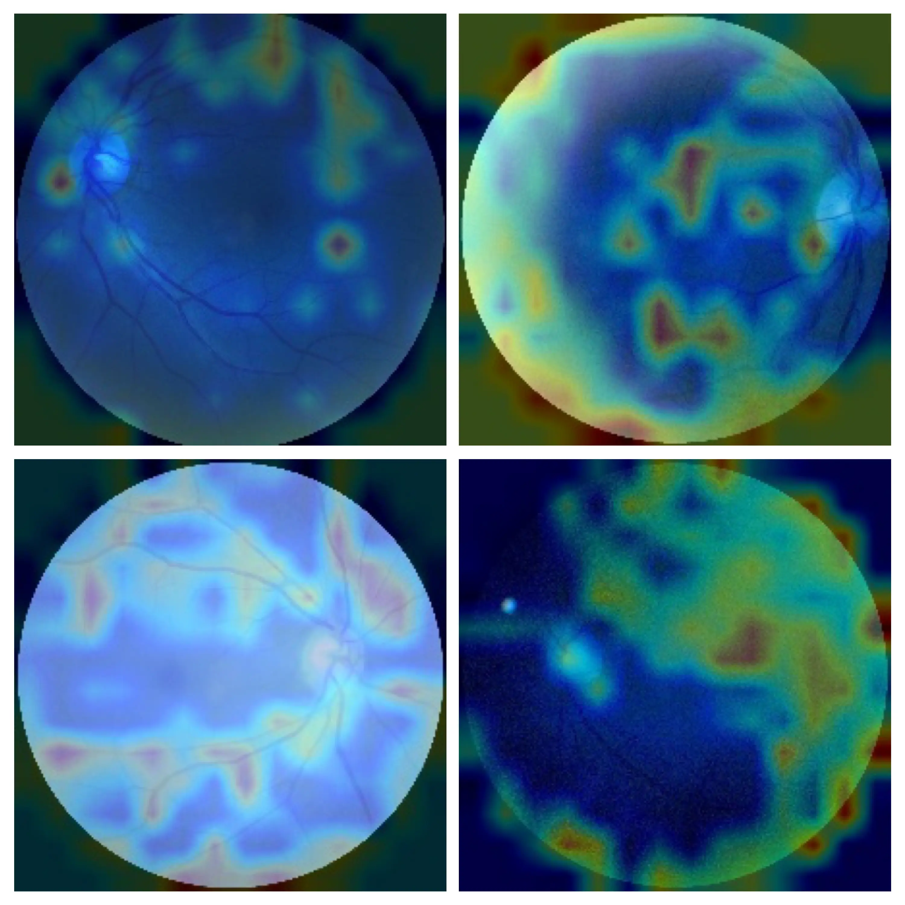 GradCAM analysis of the attention maps of the Vision Transformer. The top row consists of fundus images of diabetic and normal patients with minimum entropy. The bottom row consists of fundus images of diabetic and normal patients with maximum entropy. On top of these images, we apply the attention map computed using GradCAM to understand which parts are considered important by the model.